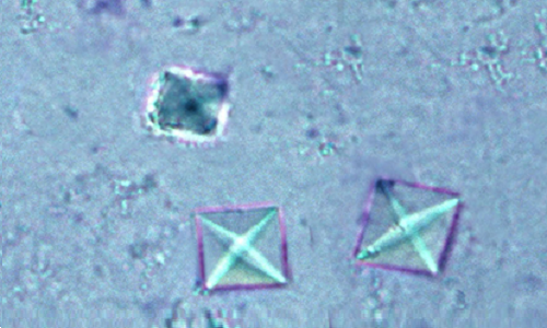 顕微鏡で見た尿結晶